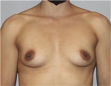 Breast Augmentation Before Photo by Keyian Paydar, MD, FACS; Newport Beach, CA - Case 46805