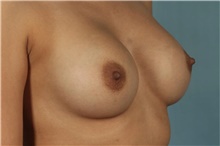 Breast Augmentation After Photo by Keyian Paydar, MD, FACS; Newport Beach, CA - Case 46806