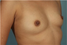 Breast Augmentation Before Photo by Keyian Paydar, MD, FACS; Newport Beach, CA - Case 46806