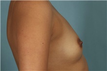 Breast Augmentation Before Photo by Keyian Paydar, MD, FACS; Newport Beach, CA - Case 46806