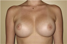 Breast Augmentation After Photo by Keyian Paydar, MD, FACS; Newport Beach, CA - Case 46807