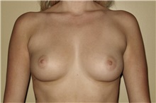 Breast Augmentation Before Photo by Keyian Paydar, MD, FACS; Newport Beach, CA - Case 46807