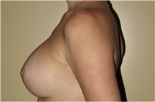 Breast Augmentation After Photo by Keyian Paydar, MD, FACS; Newport Beach, CA - Case 46807