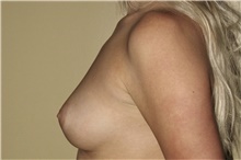 Breast Augmentation Before Photo by Keyian Paydar, MD, FACS; Newport Beach, CA - Case 46807