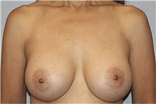 Breast Augmentation After Photo by Keyian Paydar, MD, FACS; Newport Beach, CA - Case 46811