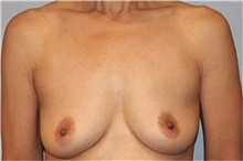 Breast Augmentation Before Photo by Keyian Paydar, MD, FACS; Newport Beach, CA - Case 46811