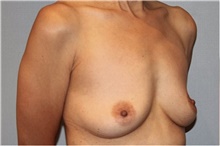 Breast Augmentation Before Photo by Keyian Paydar, MD, FACS; Newport Beach, CA - Case 46811