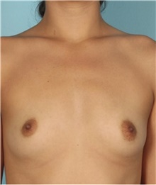 Breast Augmentation Before Photo by Keyian Paydar, MD, FACS; Newport Beach, CA - Case 46812