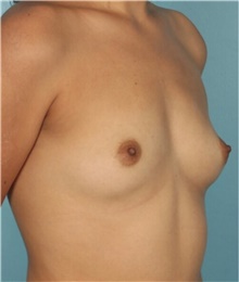 Breast Augmentation Before Photo by Keyian Paydar, MD, FACS; Newport Beach, CA - Case 46812