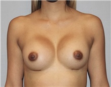 Breast Augmentation After Photo by Keyian Paydar, MD, FACS; Newport Beach, CA - Case 46813