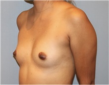 Breast Augmentation Before Photo by Keyian Paydar, MD, FACS; Newport Beach, CA - Case 46813