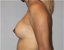 Breast Augmentation After Photo by Keyian Paydar, MD, FACS; Newport Beach, CA - Case 46813