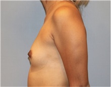 Breast Augmentation Before Photo by Keyian Paydar, MD, FACS; Newport Beach, CA - Case 46813