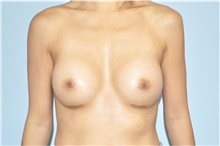 Breast Augmentation After Photo by Keyian Paydar, MD, FACS; Newport Beach, CA - Case 46815