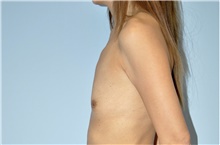 Breast Augmentation Before Photo by Keyian Paydar, MD, FACS; Newport Beach, CA - Case 46815