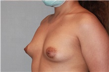 Breast Augmentation Before Photo by Keyian Paydar, MD, FACS; Newport Beach, CA - Case 46816