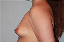 Breast Augmentation Before Photo by Keyian Paydar, MD, FACS; Newport Beach, CA - Case 46816