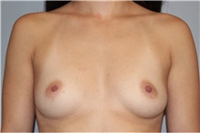 Breast Augmentation Before Photo by Keyian Paydar, MD, FACS; Newport Beach, CA - Case 46817