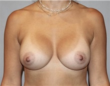 Breast Augmentation After Photo by Keyian Paydar, MD, FACS; Newport Beach, CA - Case 46818