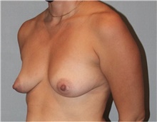 Breast Augmentation Before Photo by Keyian Paydar, MD, FACS; Newport Beach, CA - Case 46818