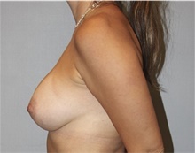 Breast Augmentation After Photo by Keyian Paydar, MD, FACS; Newport Beach, CA - Case 46818