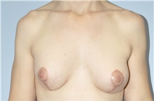 Breast Lift After Photo by Keyian Paydar, MD, FACS; Newport Beach, CA - Case 46820
