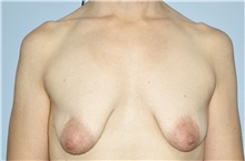 Breast Lift Before Photo by Keyian Paydar, MD, FACS; Newport Beach, CA - Case 46820