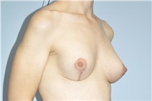 Breast Lift After Photo by Keyian Paydar, MD, FACS; Newport Beach, CA - Case 46820