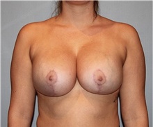 Breast Lift After Photo by Keyian Paydar, MD, FACS; Newport Beach, CA - Case 46821