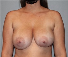 Breast Lift Before Photo by Keyian Paydar, MD, FACS; Newport Beach, CA - Case 46821