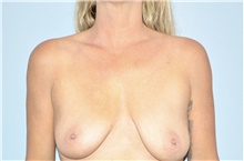 Breast Lift Before Photo by Keyian Paydar, MD, FACS; Newport Beach, CA - Case 46822