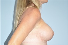 Breast Lift After Photo by Keyian Paydar, MD, FACS; Newport Beach, CA - Case 46822