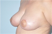 Breast Lift After Photo by Keyian Paydar, MD, FACS; Newport Beach, CA - Case 46823