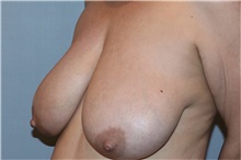 Breast Lift Before Photo by Keyian Paydar, MD, FACS; Newport Beach, CA - Case 46823