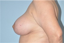 Breast Lift After Photo by Keyian Paydar, MD, FACS; Newport Beach, CA - Case 46823