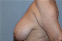 Breast Lift Before Photo by Keyian Paydar, MD, FACS; Newport Beach, CA - Case 46823