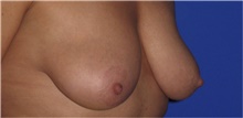Breast Lift Before Photo by Keyian Paydar, MD, FACS; Newport Beach, CA - Case 46824