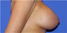 Breast Lift After Photo by Keyian Paydar, MD, FACS; Newport Beach, CA - Case 46824