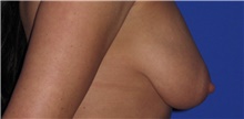 Breast Lift Before Photo by Keyian Paydar, MD, FACS; Newport Beach, CA - Case 46824