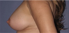 Body Lift After Photo by Keyian Paydar, MD, FACS; Newport Beach, CA - Case 46825