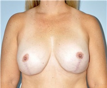 Breast Lift After Photo by Keyian Paydar, MD, FACS; Newport Beach, CA - Case 46827