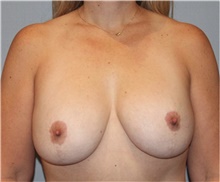 Breast Lift Before Photo by Keyian Paydar, MD, FACS; Newport Beach, CA - Case 46827