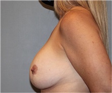 Breast Lift Before Photo by Keyian Paydar, MD, FACS; Newport Beach, CA - Case 46827