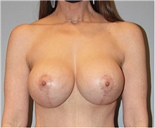 Breast Lift After Photo by Keyian Paydar, MD, FACS; Newport Beach, CA - Case 46829