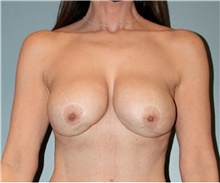 Breast Lift Before Photo by Keyian Paydar, MD, FACS; Newport Beach, CA - Case 46829