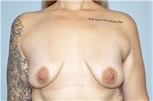 Breast Lift Before Photo by Keyian Paydar, MD, FACS; Newport Beach, CA - Case 46830