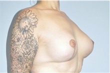 Breast Lift After Photo by Keyian Paydar, MD, FACS; Newport Beach, CA - Case 46830