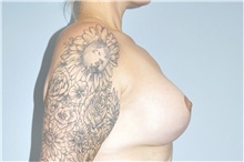 Breast Lift After Photo by Keyian Paydar, MD, FACS; Newport Beach, CA - Case 46830