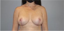 Breast Lift After Photo by Keyian Paydar, MD, FACS; Newport Beach, CA - Case 46831