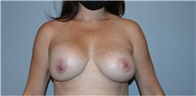Breast Lift Before Photo by Keyian Paydar, MD, FACS; Newport Beach, CA - Case 46831